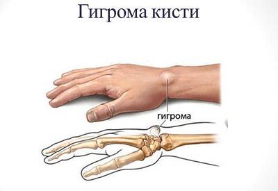Гигрома. Что это такое?