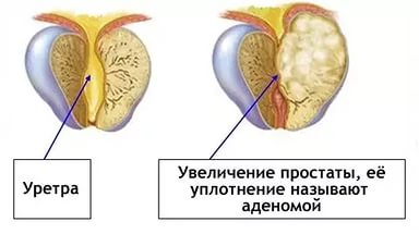 Аденома простаты