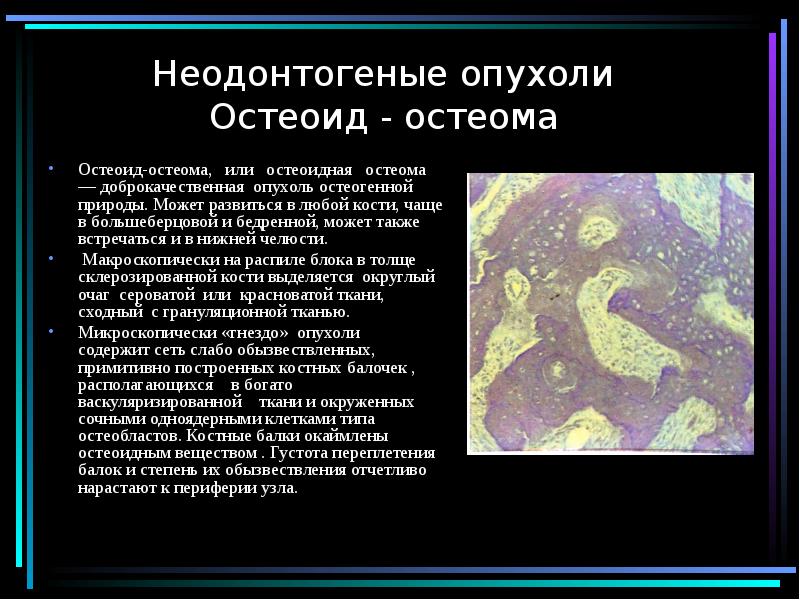 Рентгенологические признаки остеомы