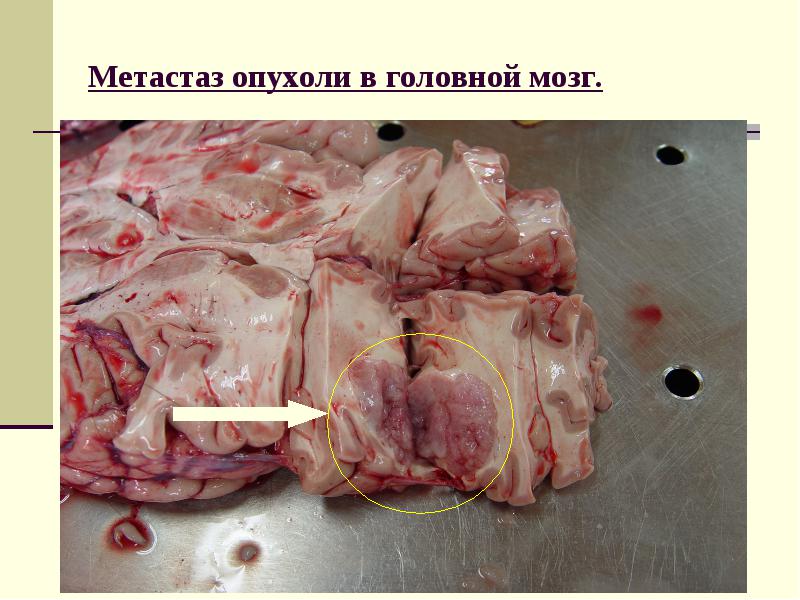 Рак головного мозга симптомы