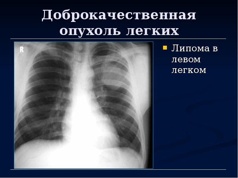 Липома легкого