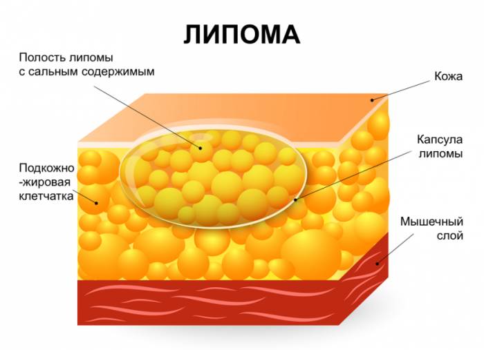 Строение липомы