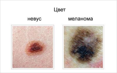 Отличие невуса от меланомы по цвету