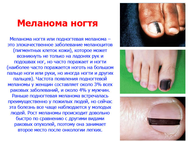 Симптомы и лечение подногтевой меланомы
