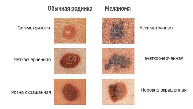 Родинка или меланома?