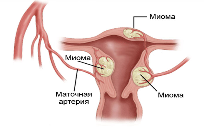 ЭСТРОГЕНОЗАВИСИМЫЕ ОПУХОЛИ