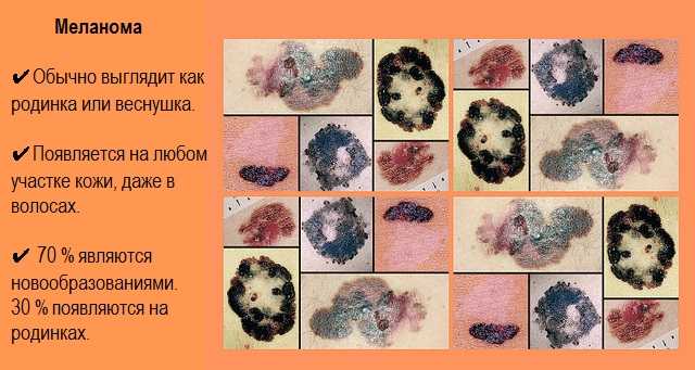 Меланома 4 стадии