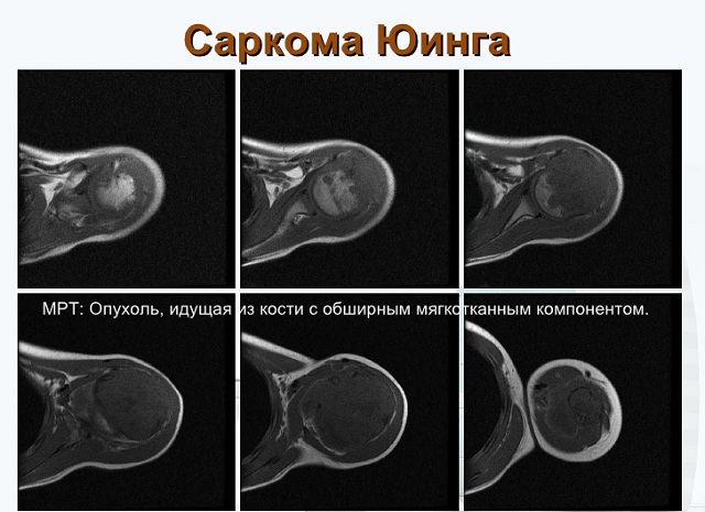 Злокачественная опухоль у ребенка