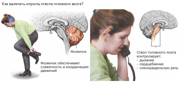 Опухоль ствола головного мозга