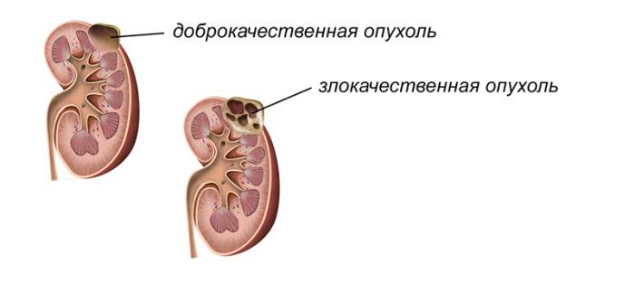 Бластома почки – что это такое?