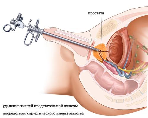 Как проводится операция по удалению аденомы простаты