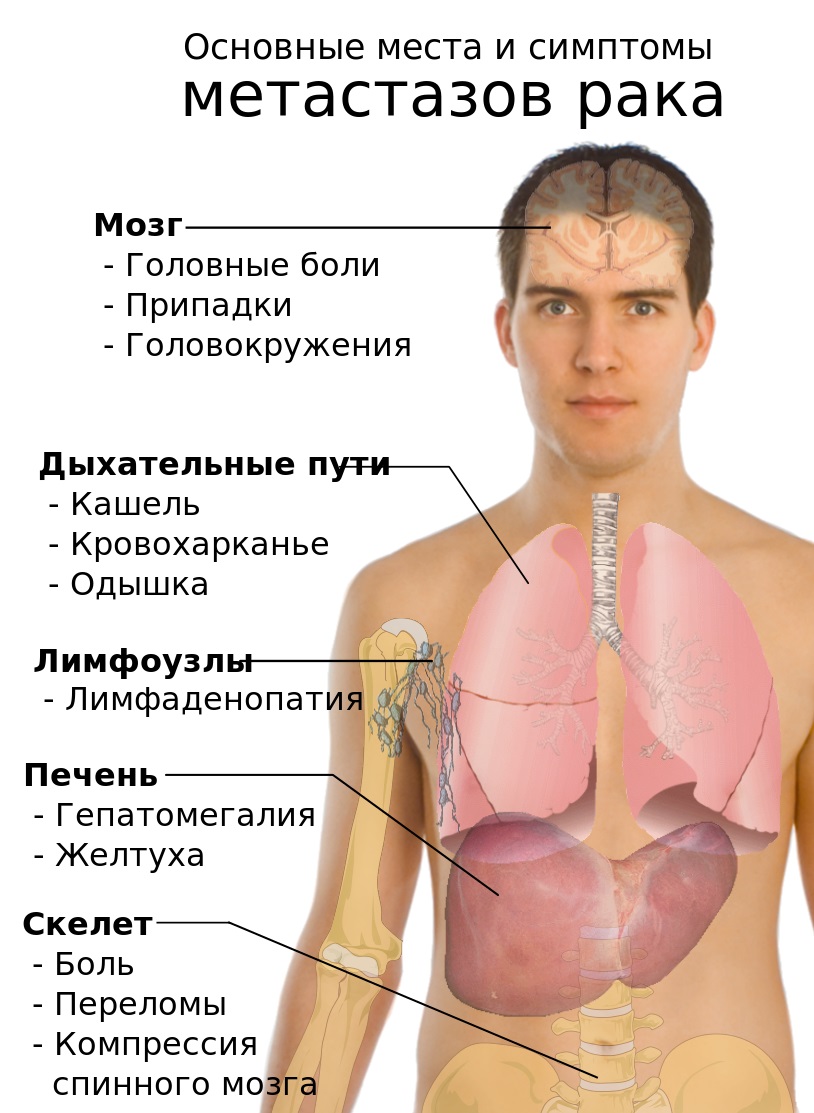 Метастаз Вирхова