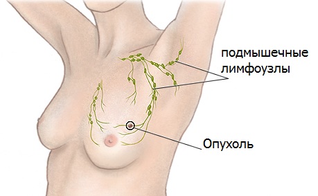 Опухоль молочной железы