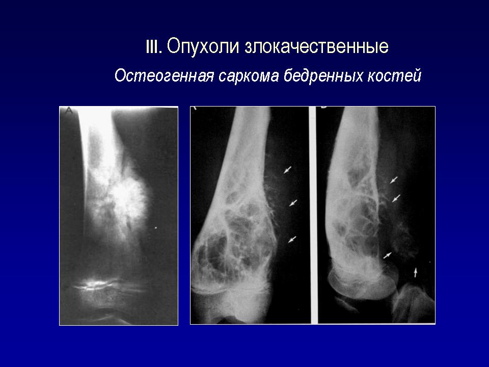 Остеогенная саркома