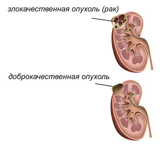 Рак почек