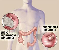 Рак прямой кишки
