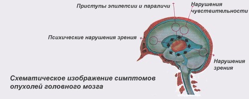 Саркома головного мозга