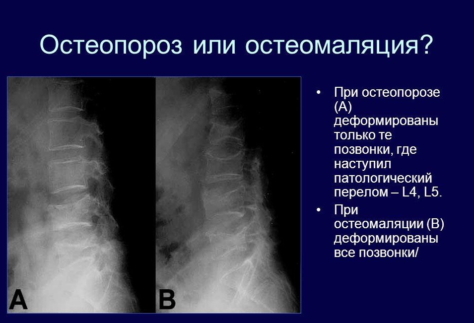 Остеомаляция