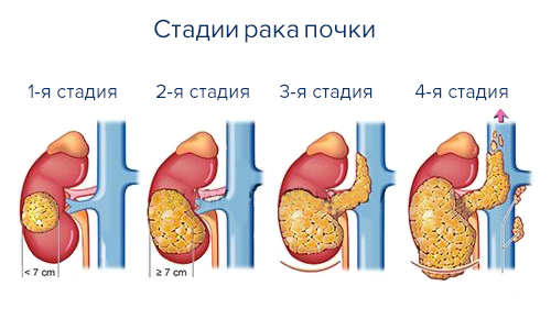 Рак почек