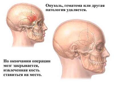 Лечение опухли головного мозга