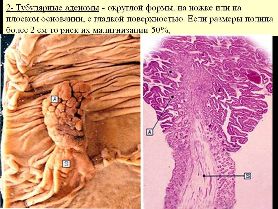 Ворсинчатая аденома прямой кишки