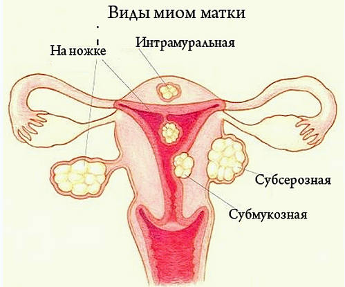 Миома.Лечение народными средствами