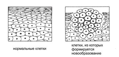  лимфомы