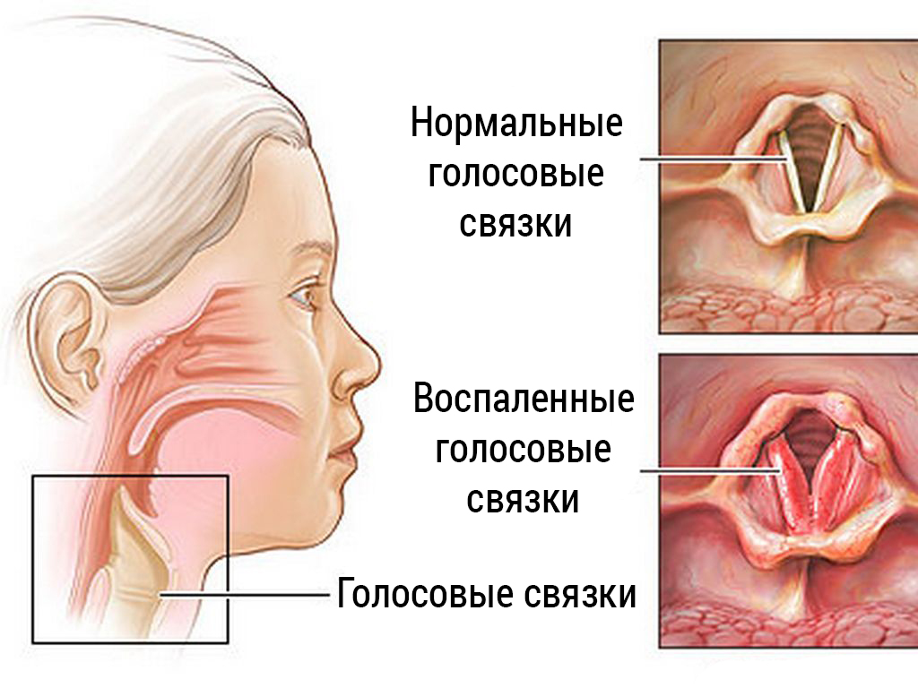 Фиброма голосовой связки