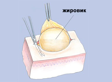 Липома