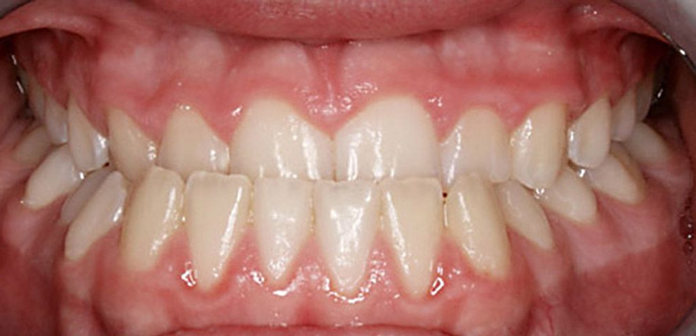 Мезиальный прикус: как обнаружить и вылечить? - фото 1