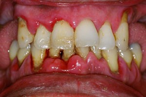 Гранулированный периодонтит - фото 1