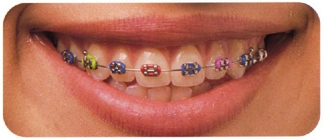 От чего зависит стоимость брекетов? - фото 1