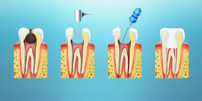 Лечение пульпита без удаления нерва: стадии и особенности - фото 1