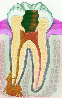 Периодонтит: профилактика - фото 1