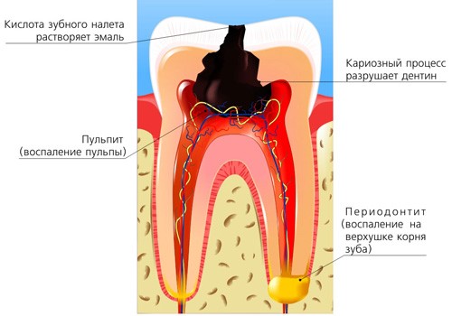 Апикальный периодонтит: этиология, клиника, диагностика и лечение - фото 1
