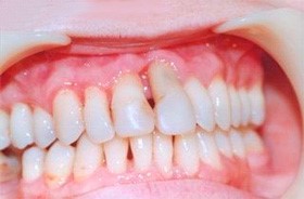 Генерализованный пародонтит