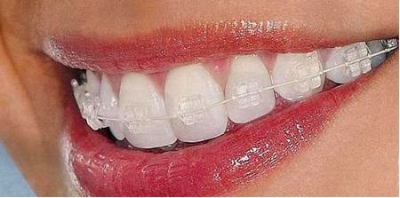 Эстетическая ортодонтия – прозрачные брекеты - фото 1