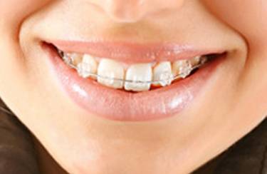 Керамические брекеты: плюсы и минусы - фото 1