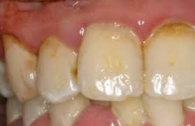 Зубной камень