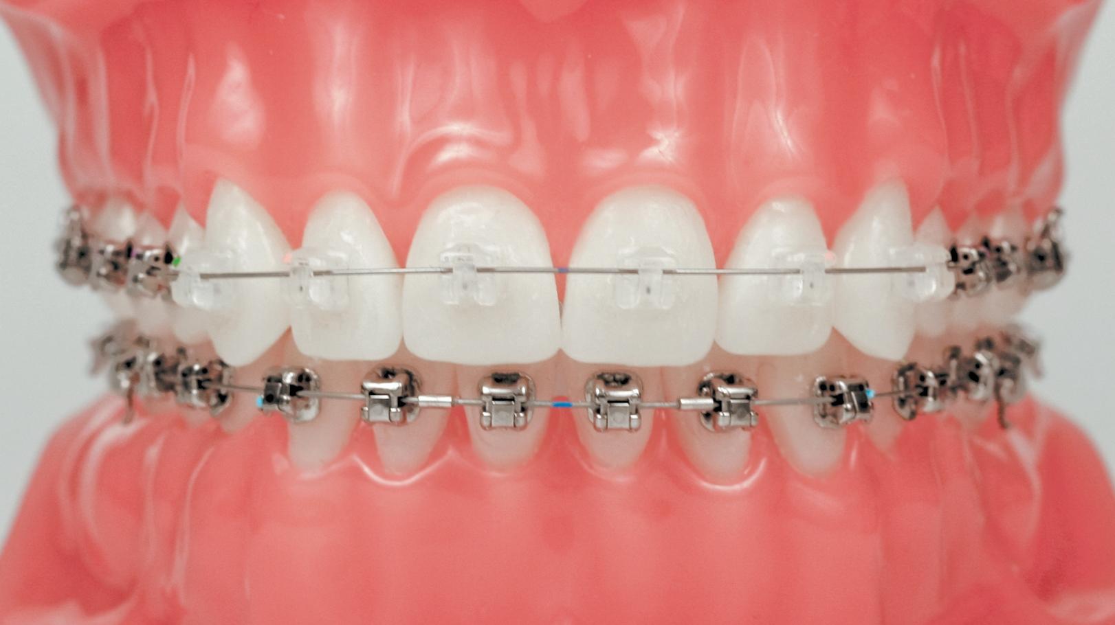 Лечение неправильного прикуса брекет-системами - фото 1