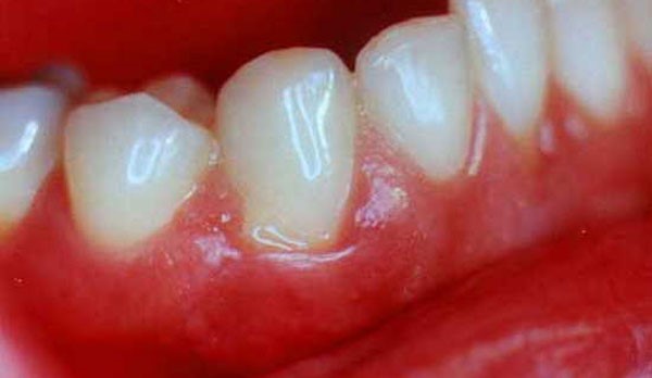 пародонтит