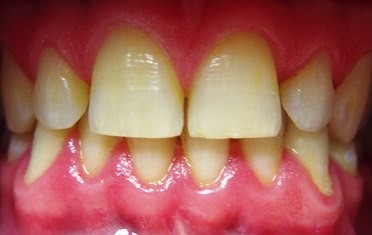 Характерные признаки начальной стадии болезни