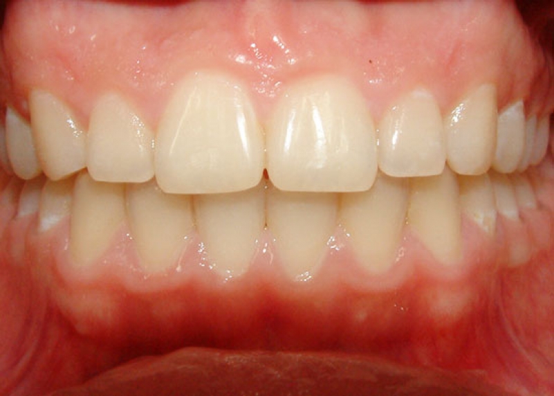 Отличительные особенности глубокого прикуса - фото 1