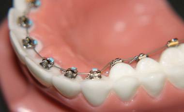 Невидимые брекеты: виды и их особенности - фото 1