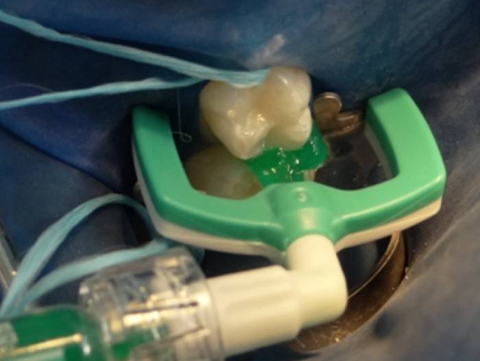 Лечение посредством инфильтрации