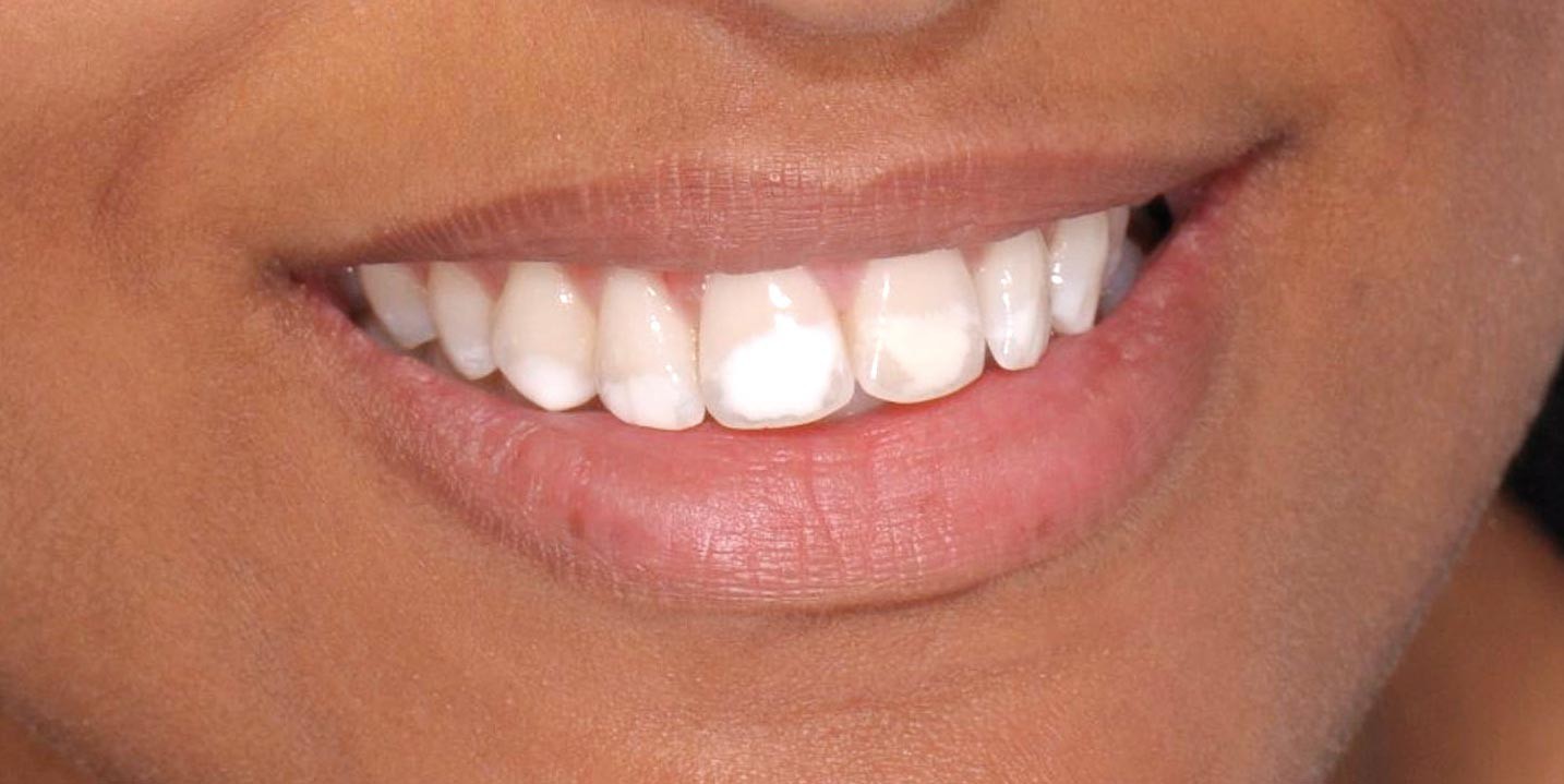 флюороз зубной эмали