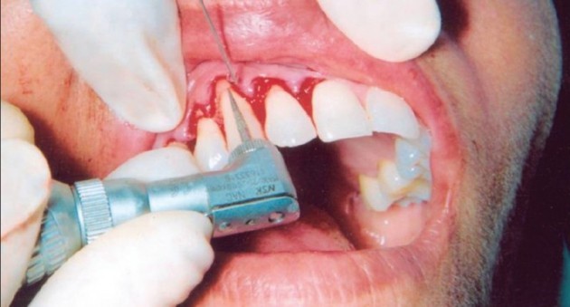 Пришеечный кариес: причины, стадии, лечение, профилактика - фото 9