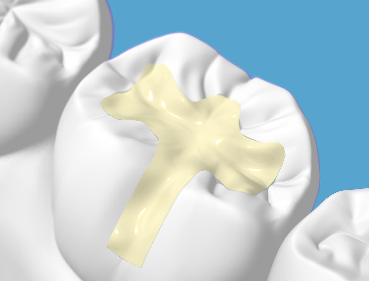 Зубная пломба