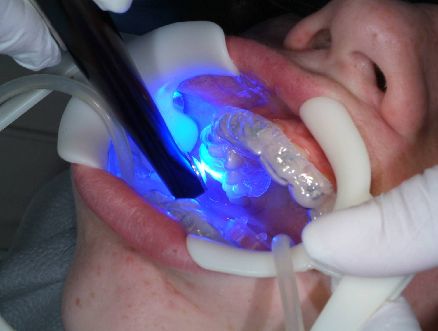 Этиология и методы лечения кариеса в стадии пятна - фото 9