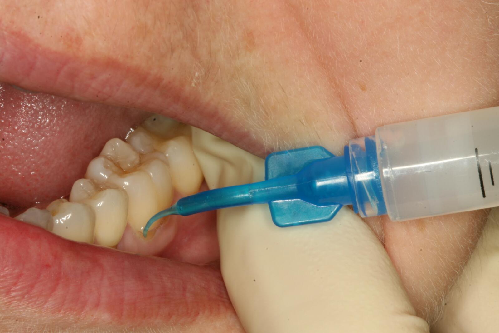 лечение кариеса азоном